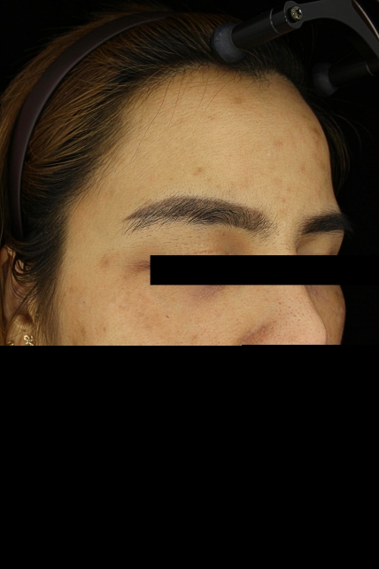 기미·색소 치료 후 사진 03