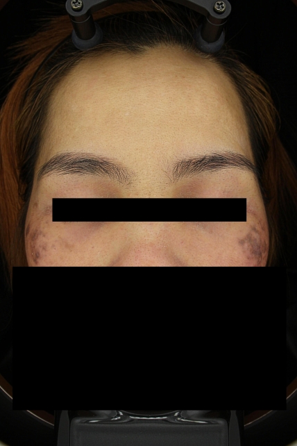 기미·색소 치료 전 대표 사진 01