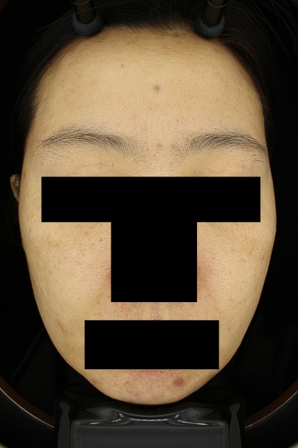 기미·색소 치료 후 대표 사진 02