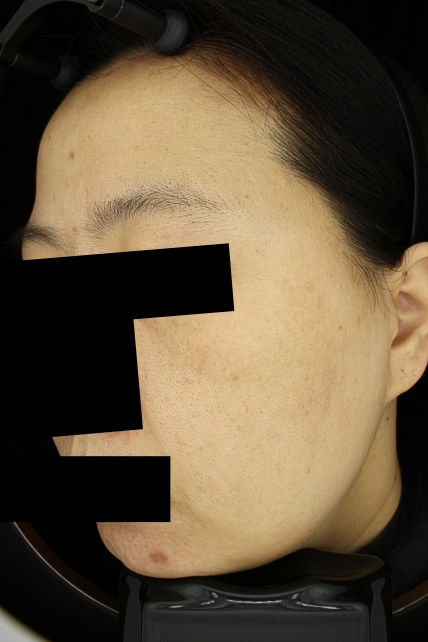 기미·색소 치료 후 사진 02