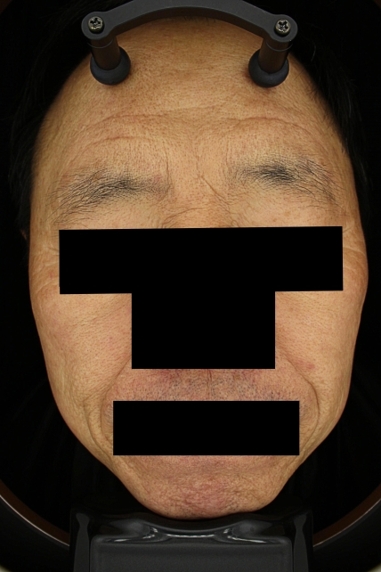 기미·색소 치료 후 대표 사진 03