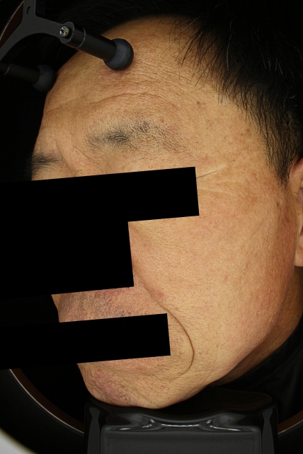검버섯 치료 치료 후 대표 사진