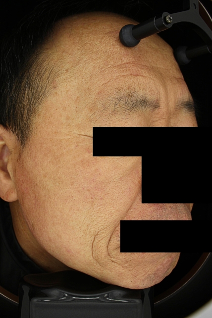 기미·색소 치료 후 사진 03