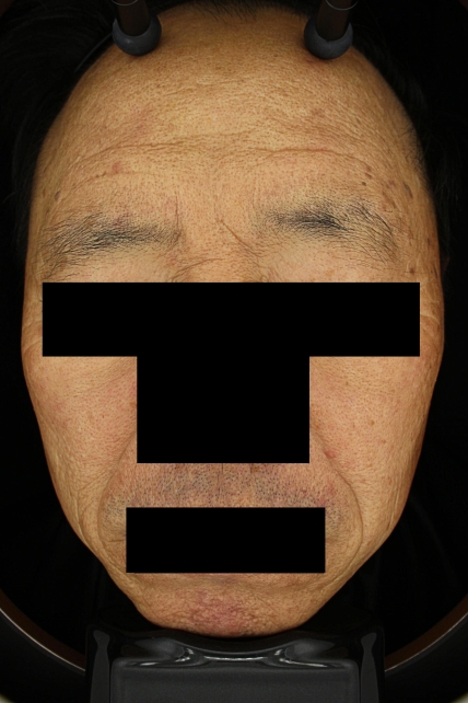 기미·색소 치료 전 대표 사진 03