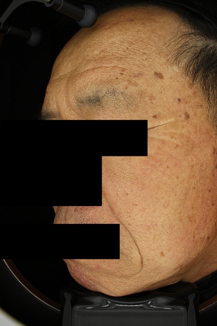 검버섯 치료 치료 전 대표 사진