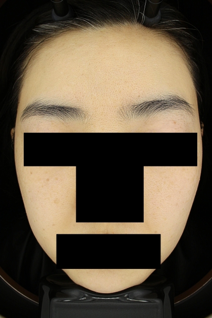 기미·색소 치료 후 대표 사진 04