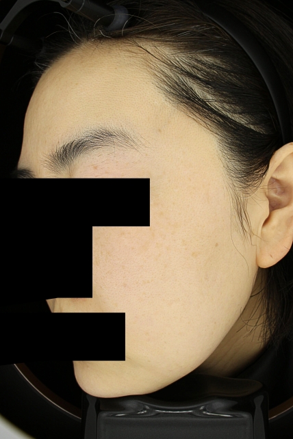 기미·색소 치료 후 사진 02