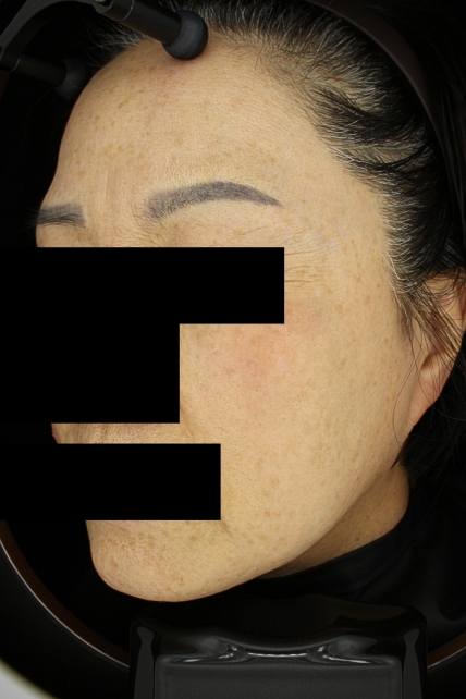 일광흑자 치료 치료 후 대표 사진