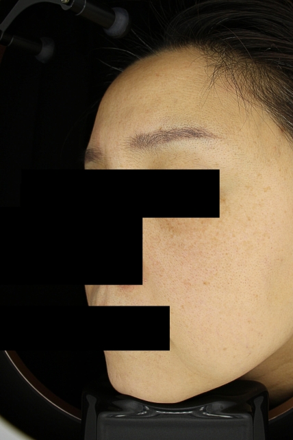 기미·색소 치료 후 사진 02
