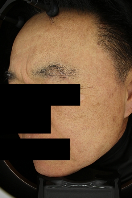 기미·색소 치료 후 사진 02