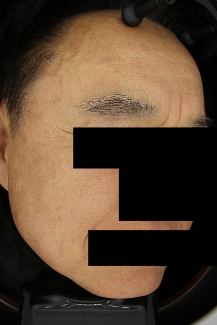 기미·색소 치료 후 사진 03