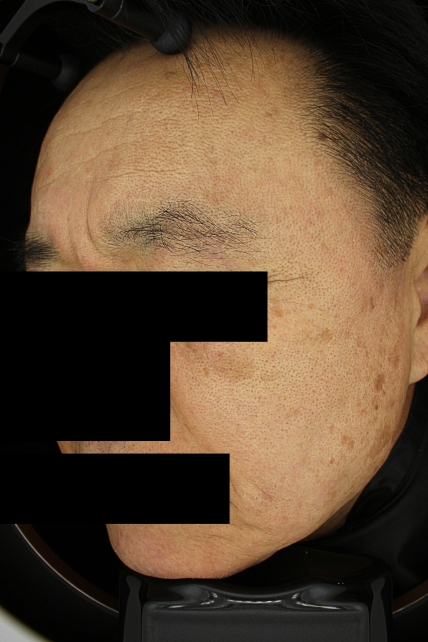 기미·색소 치료 전 사진 02