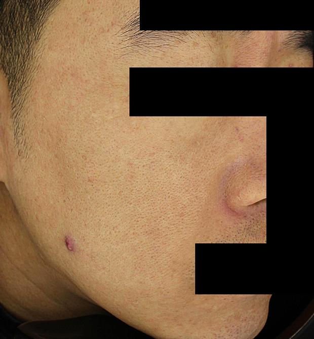 기미·색소 치료 후 사진 02