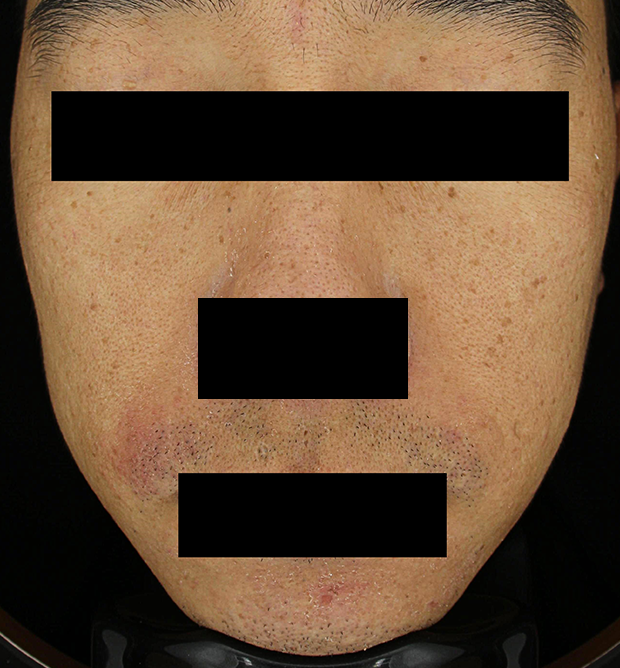 기미·색소 치료 전 대표 사진 100