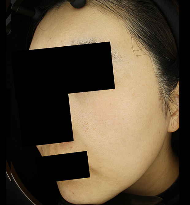 기미·색소 치료 후 사진 02
