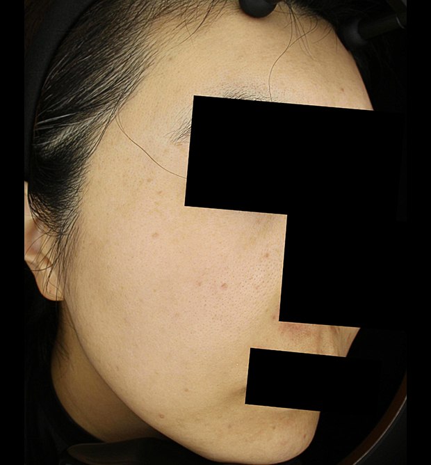 기미·색소 치료 후 사진 03