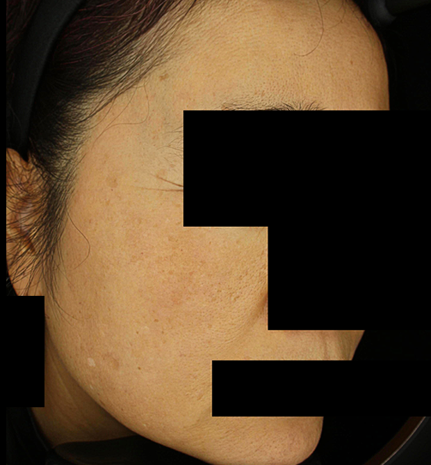 기미·색소 치료 후 사진 02