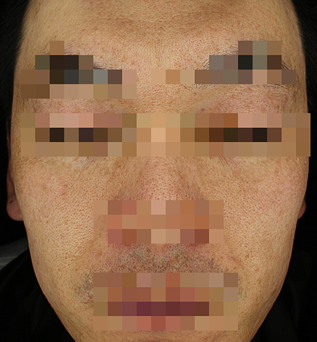 기미·색소 치료 후 대표 사진 118