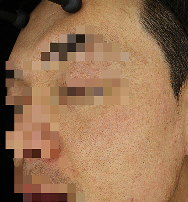 기미·색소 치료 후 사진 02