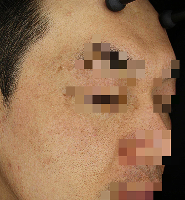 기미·색소 치료 후 사진 03