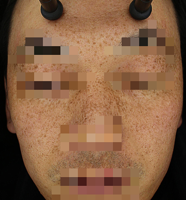 기미·색소 치료 전 대표 사진 118