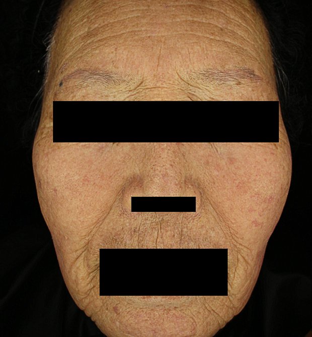 기미·색소 치료 후 대표 사진 119
