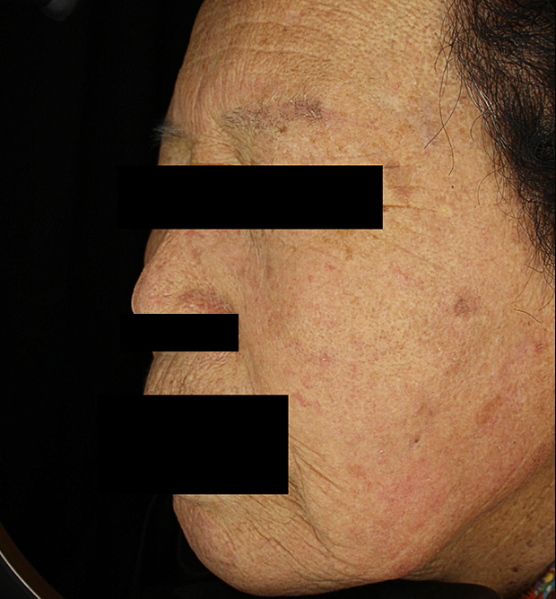 기미·색소 치료 후 사진 02
