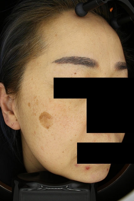 기미·색소 치료 전 사진 03