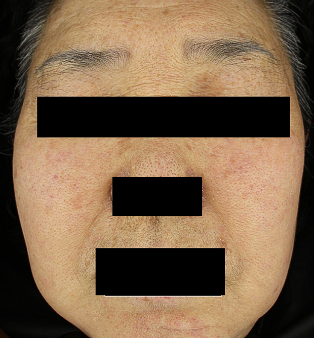 기미·색소 치료 후 대표 사진 120