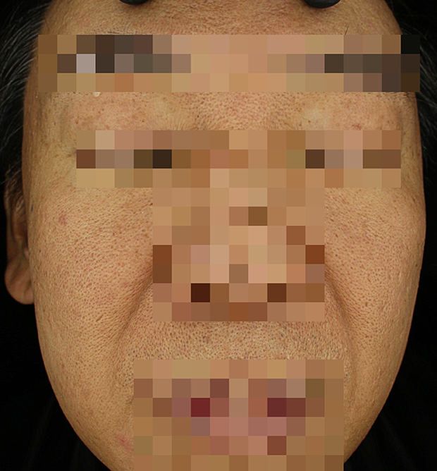 기미·색소 치료 후 대표 사진 121