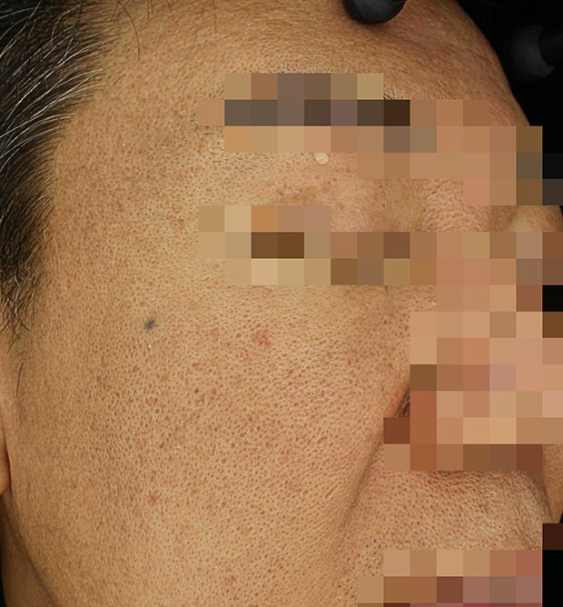 기미·색소 치료 후 사진 02