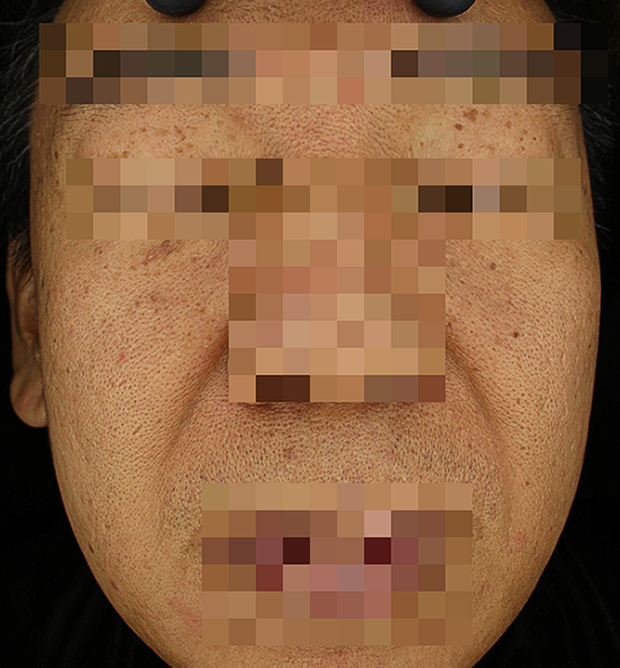 기미·색소 치료 전 대표 사진 121