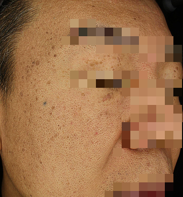 기미·색소 치료 전 사진 02