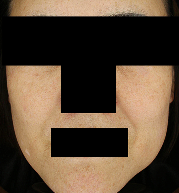 기미·색소 치료 후 대표 사진 122