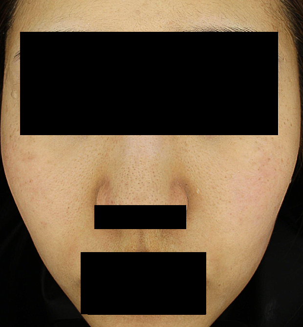 기미·색소 치료 후 대표 사진 126
