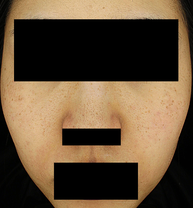 기미·색소 치료 전 대표 사진 126