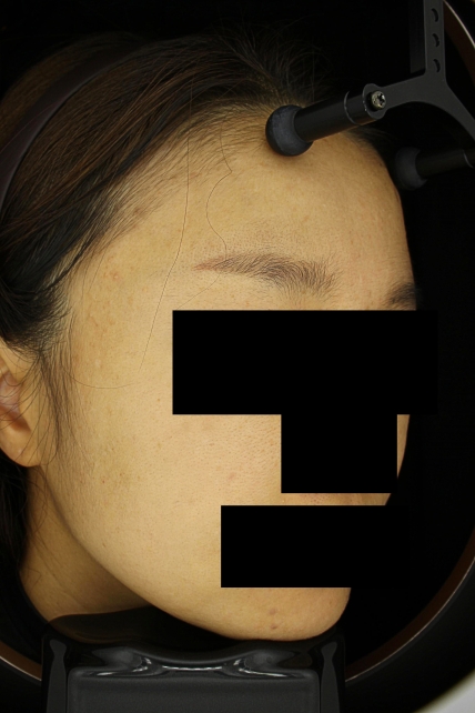 기미·색소 치료 후 사진 03