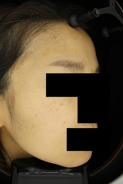기미·색소 치료 전 사진 03