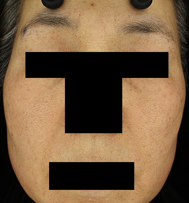 기미·색소 치료 후 대표 사진 130