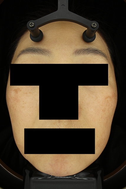 기미·색소 치료 후 대표 사진 15
