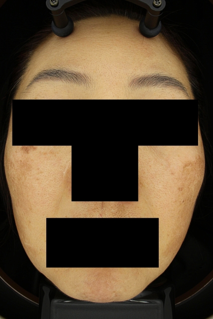 기미·색소 치료 전 대표 사진 15
