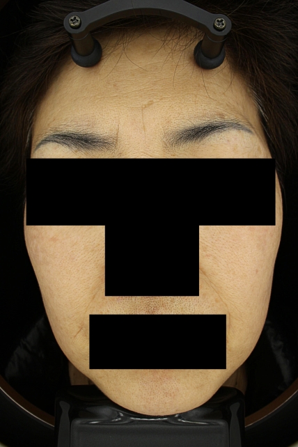 기미·색소 치료 후 대표 사진 16