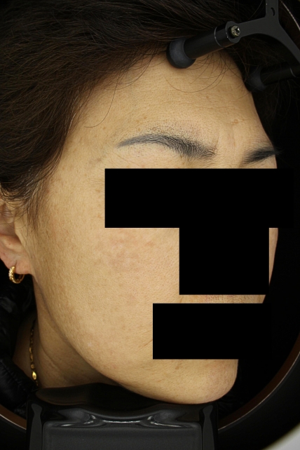 기미·색소 치료 후 사진 03