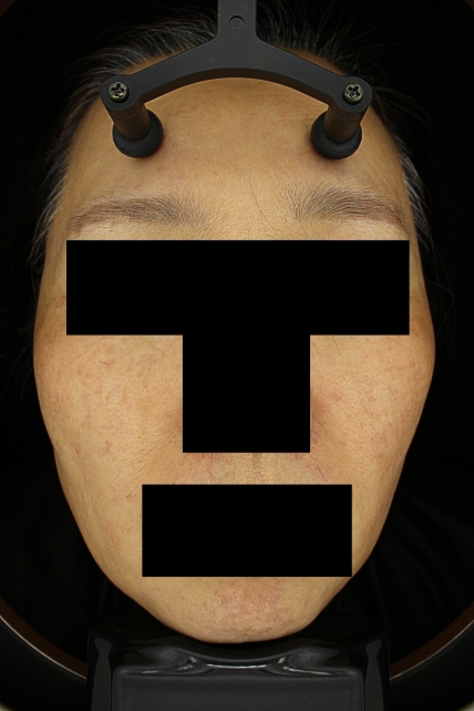 기미·색소 치료 후 대표 사진 17