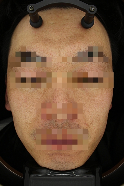 기미·색소 치료 후 대표 사진 22