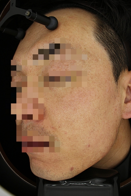 기미·색소 치료 후 사진 02