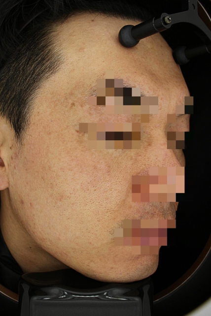 기미·색소 치료 후 사진 03
