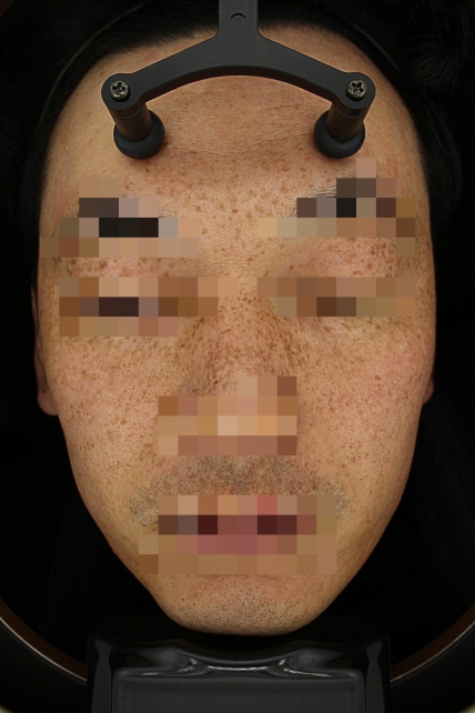 기미·색소 치료 전 대표 사진 22