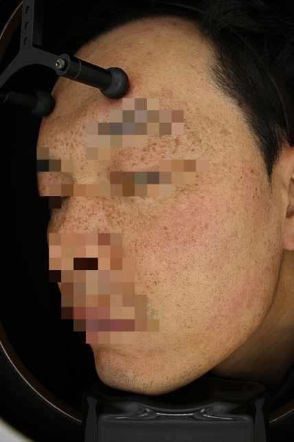 기미·색소 치료 전 사진 02