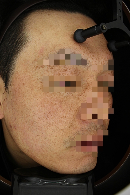기미·색소 치료 전 사진 03